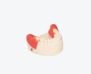 Impacted tooth extraction model