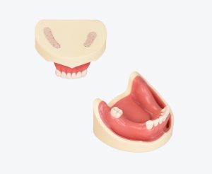 Dental Implant Training Model-Missing Tooth