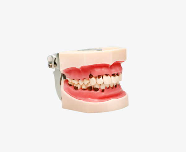 Tartar model-Medical Teeth Model