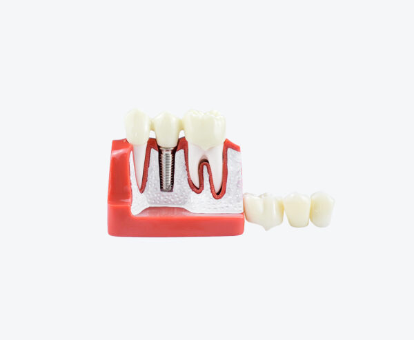Implant and gum tissue display model