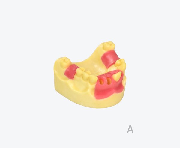 A denture-supported prosthetic with tooth models