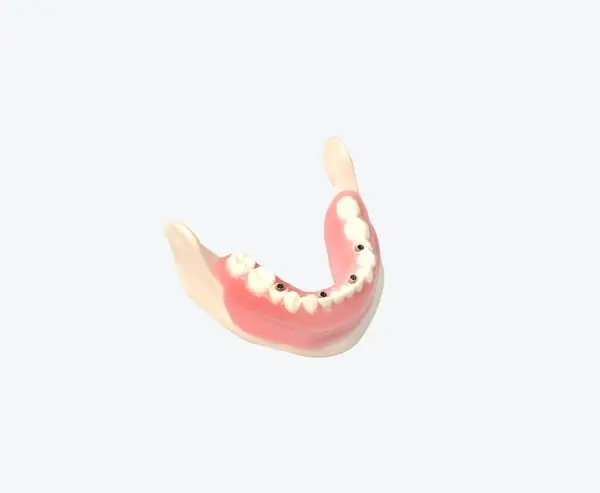 implant restoration denture shell demonstration models implant restoration denture shell demonstration models