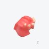 Maxillary sinus implant model