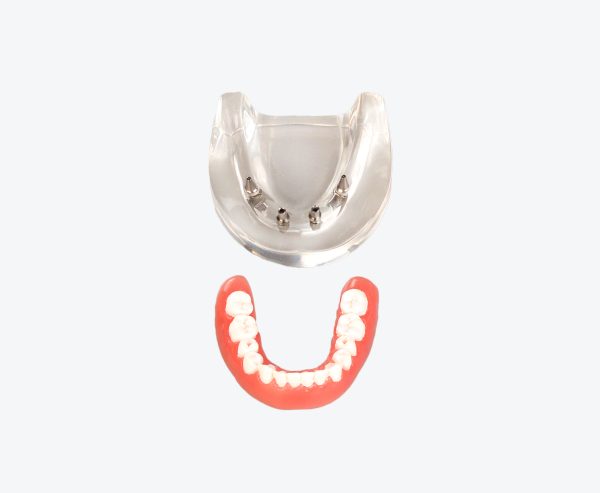 dental implant display models