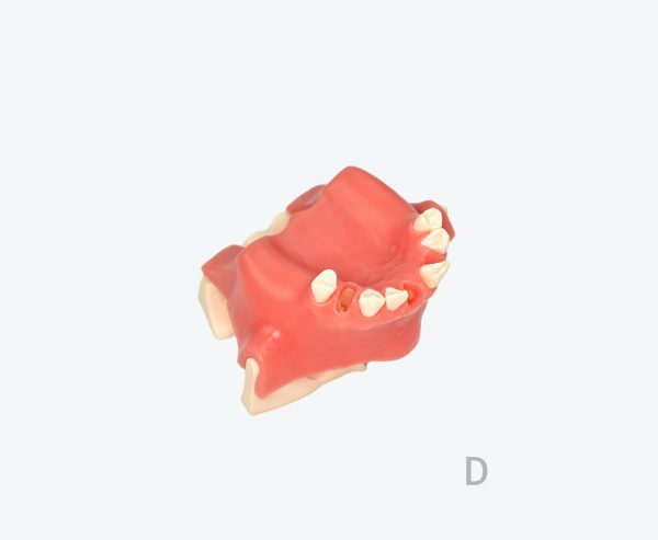 Maxillary sinus implant model
