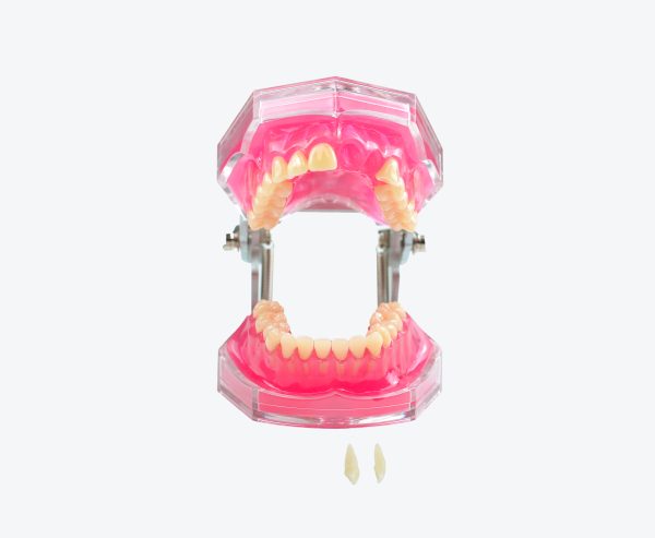Tooth Extraction Model