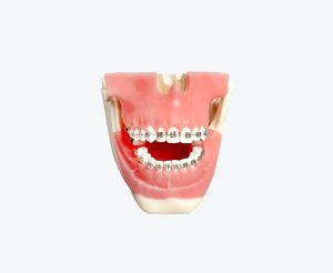 Orthodontics models
