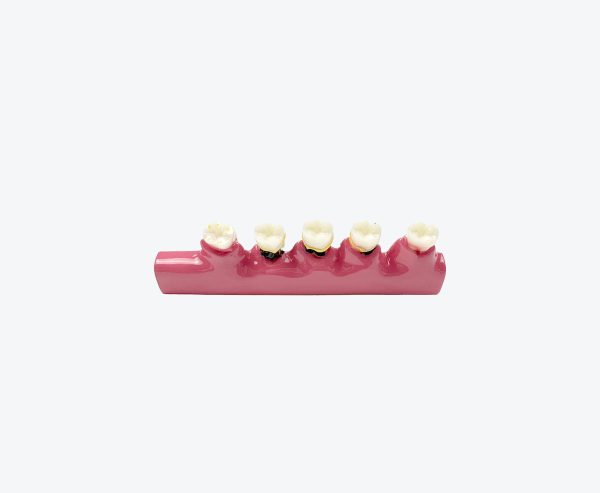 periodontitis model
