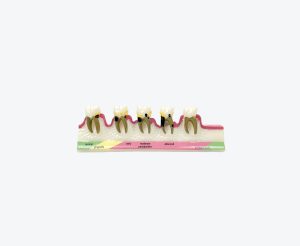 periodontitis model
