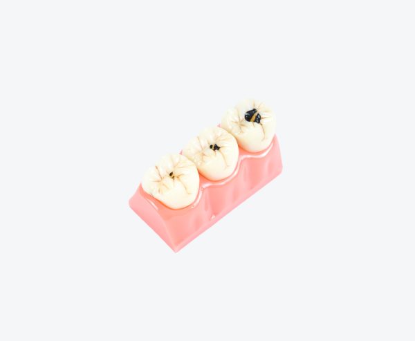 dental caries model