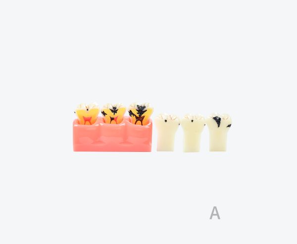 dental caries model