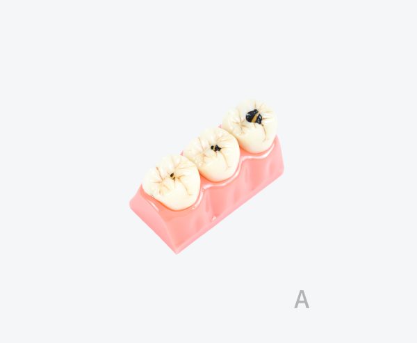 dental caries model