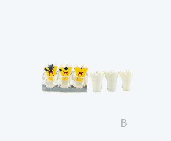 dental caries model