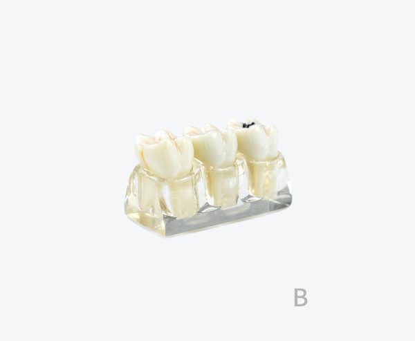 dental caries model