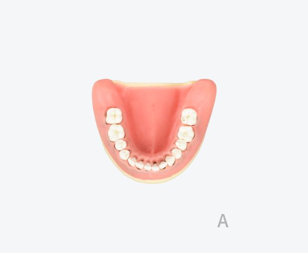 periodontitis model