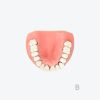 periodontitis model