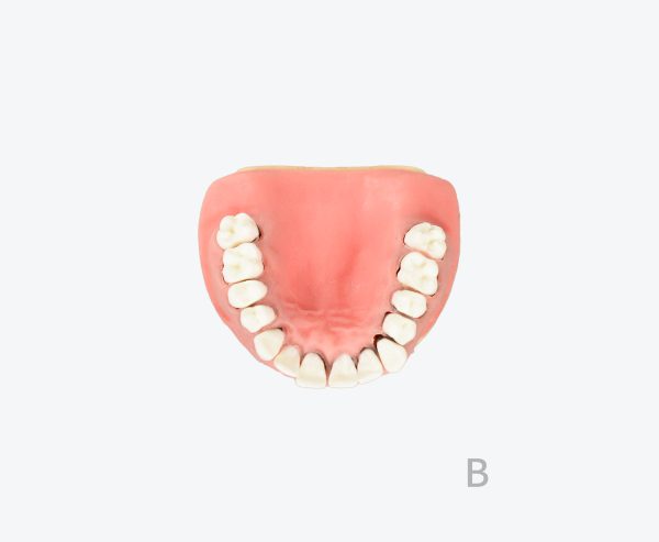 periodontitis model