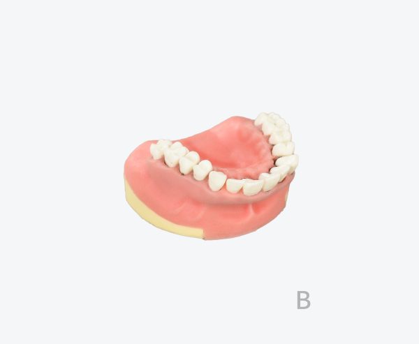 periodontitis model